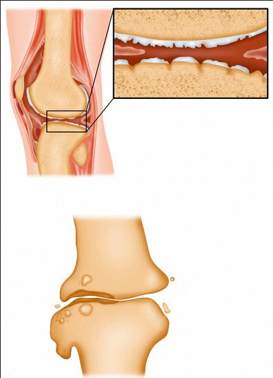 Mistletoe Injection for Osteoarthritis