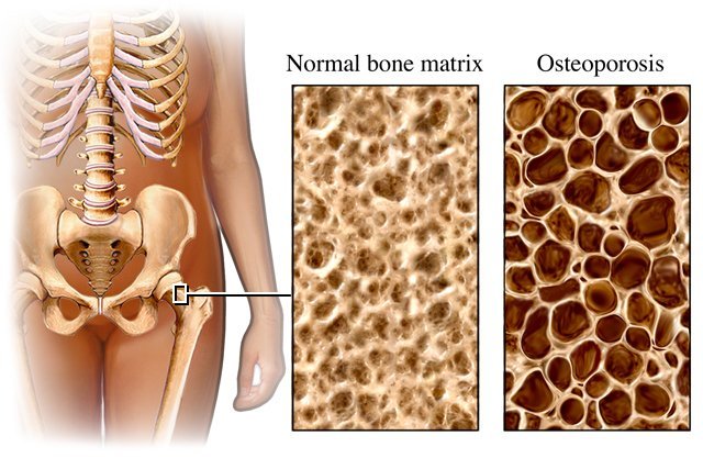 Will Calcium reverse Osteoporosis?