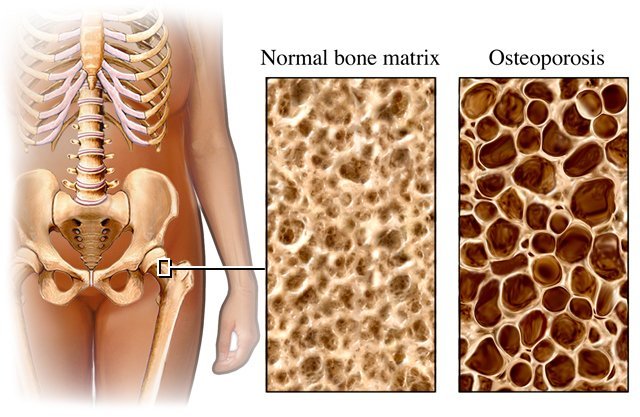 Will Calcium reverse Osteoporosis?